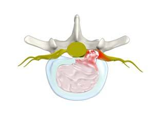 Herniated Disc